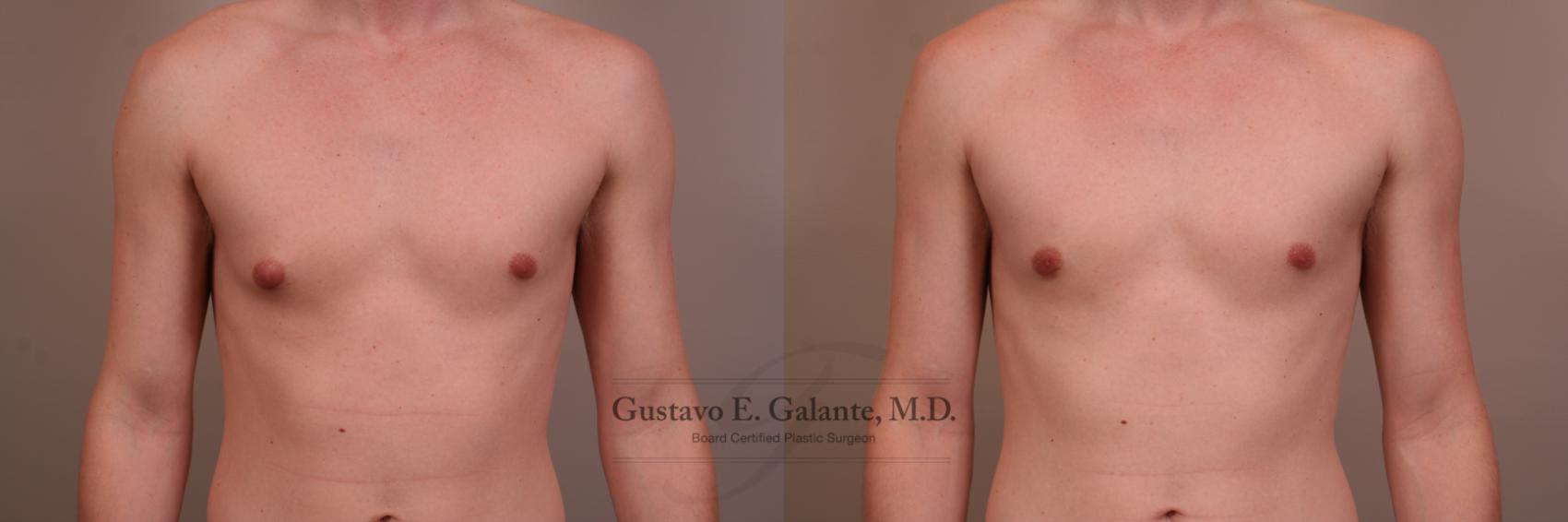 Before & After Gynecomastia Case 118 View #1 View in Schererville, IN