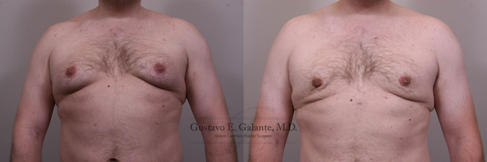 Before & After Gynecomastia Case 145 View #1 View in Schererville, IN