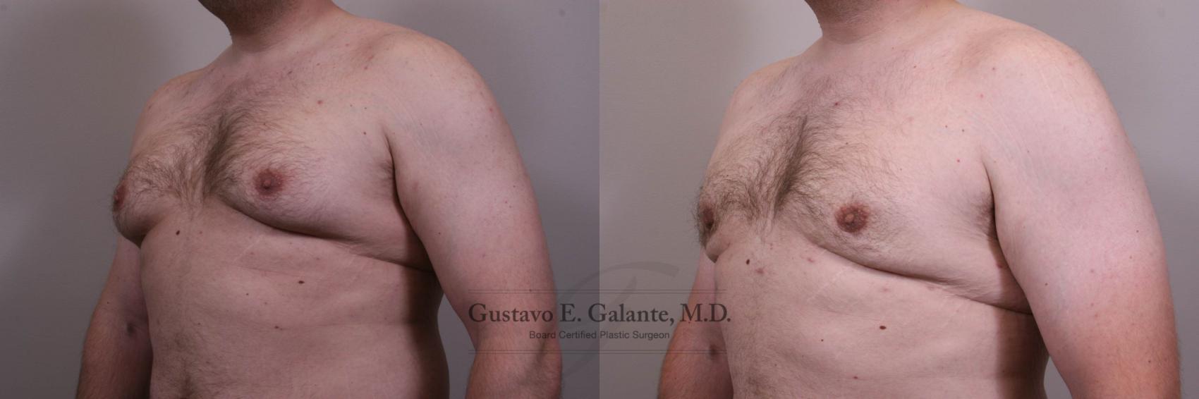 Before & After Gynecomastia Case 145 View #2 View in Schererville, IN