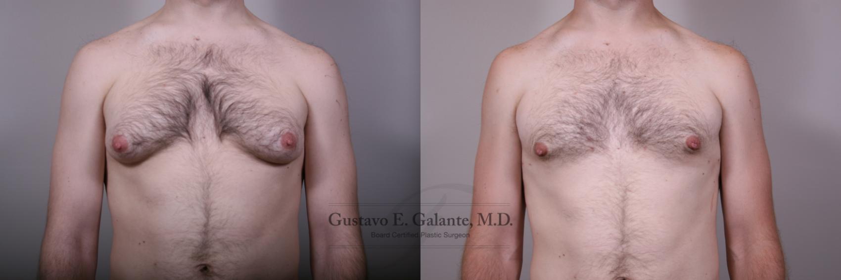 Before & After Gynecomastia Case 189 Front View in Schererville, IN