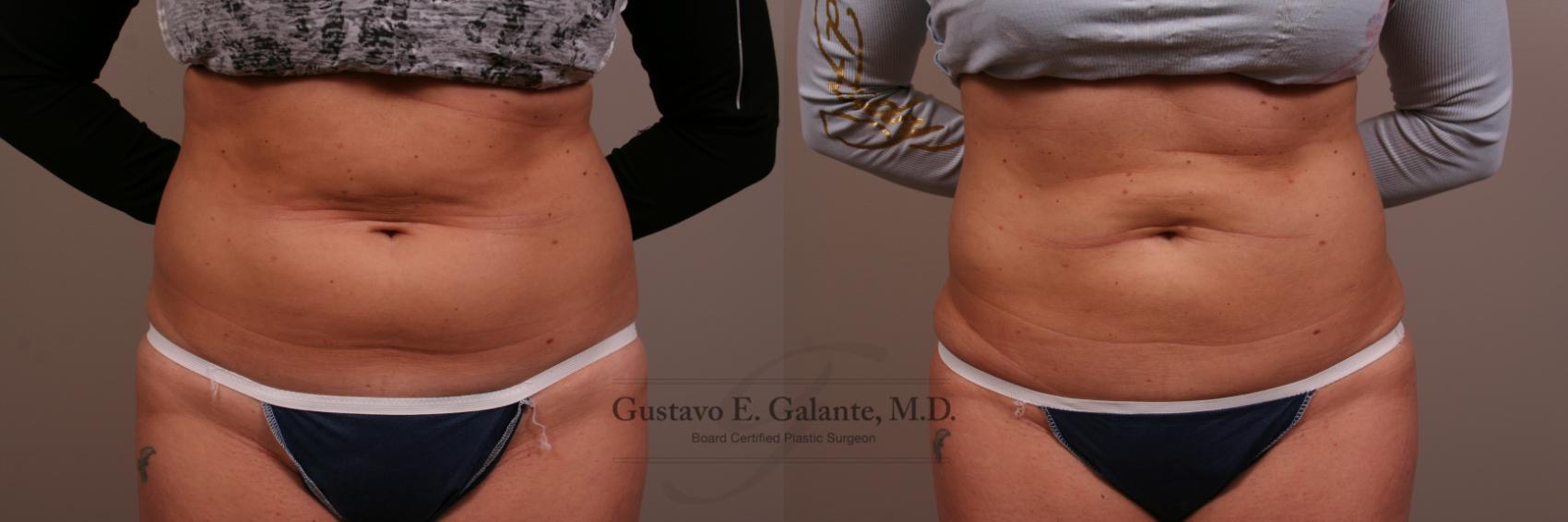 Before & After Liposuction Case 100 View #1 View in Schererville, IN