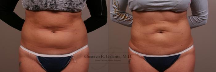 Before & After Liposuction Case 100 View #1 View in Schererville, IN