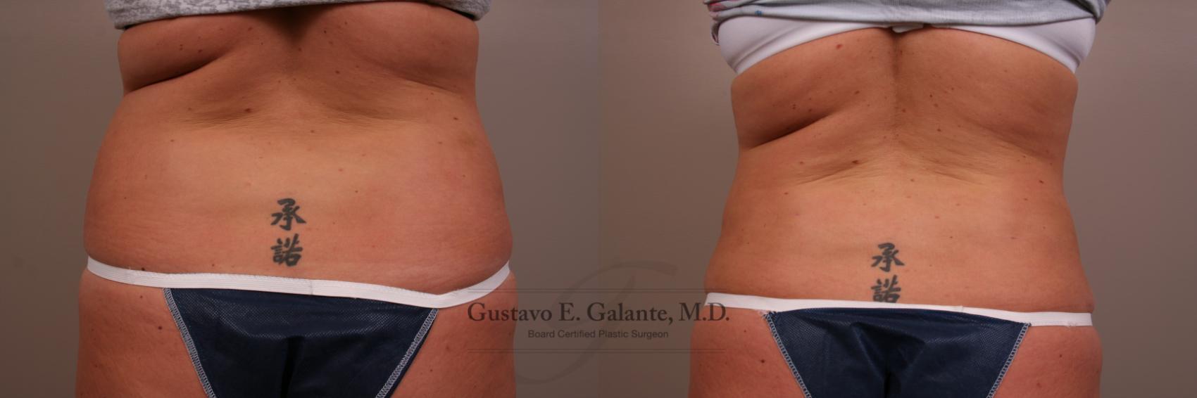 Before & After Liposuction Case 100 View #3 View in Schererville, IN