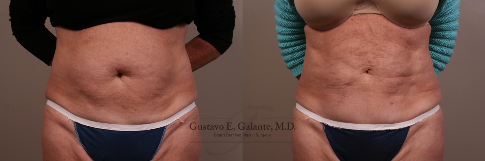 Plastic Surgery Case Study - Full Tummy Tuck and Flank Liposuction Before  Weight Loss - Explore Plastic Surgery