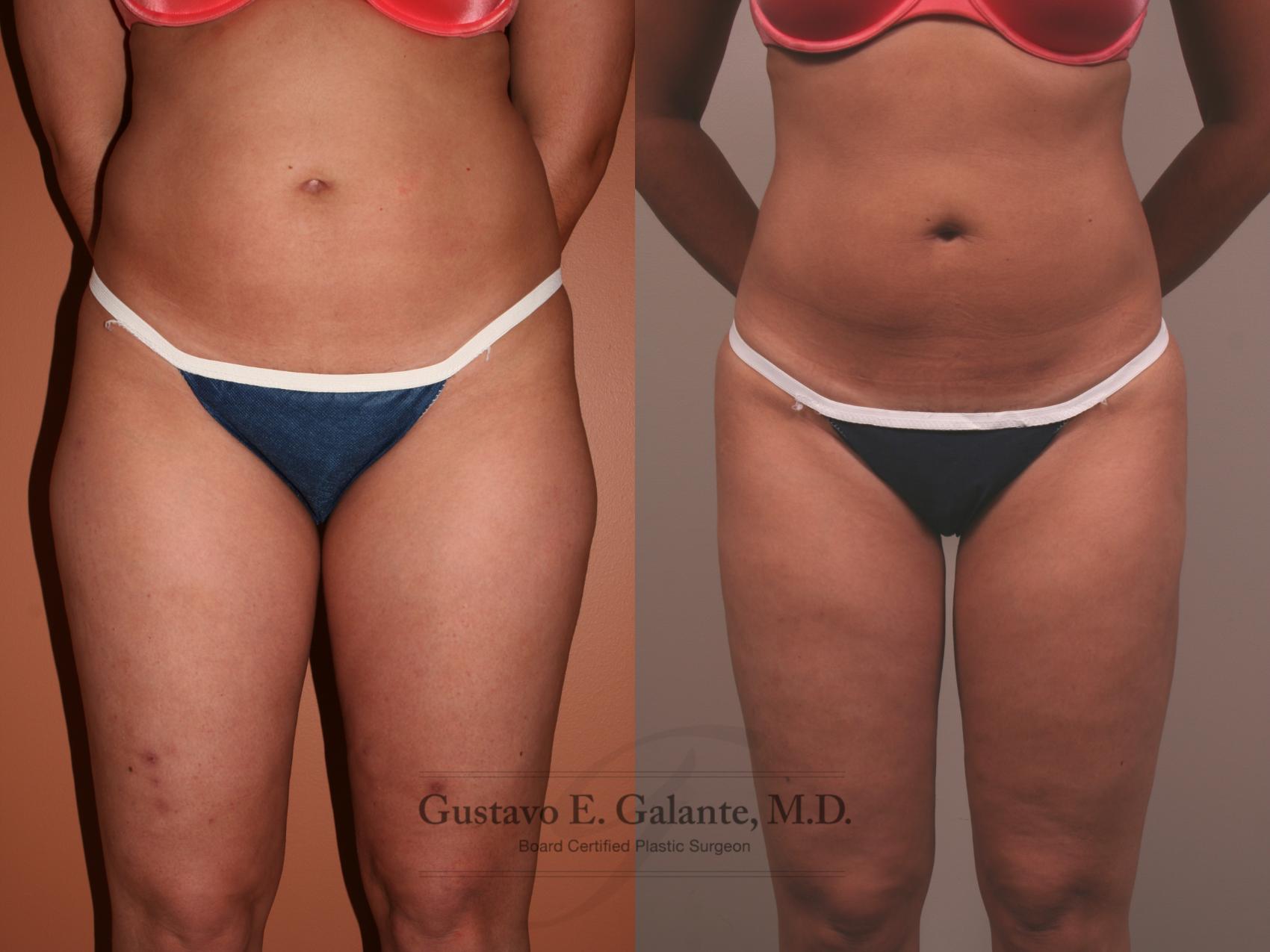Before & After Liposuction Case 110 View #1 View in Schererville, IN