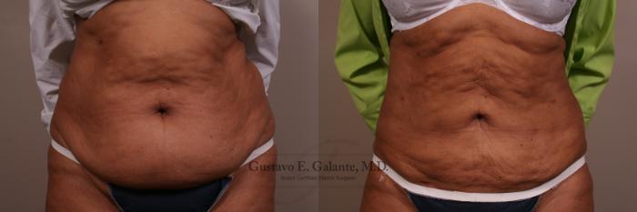 Before & After Liposuction Case 111 View #1 View in Schererville, IN