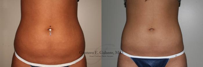Before & After Liposuction Case 132 View #1 View in Schererville, IN
