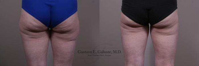 Before & After Liposuction Case 142 View #1 View in Schererville, IN