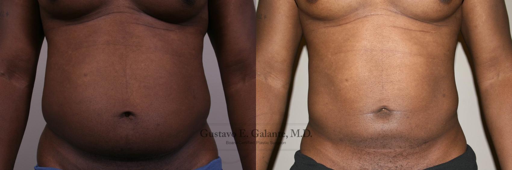 Before & After Liposuction Case 147 View #1 View in Schererville, IN