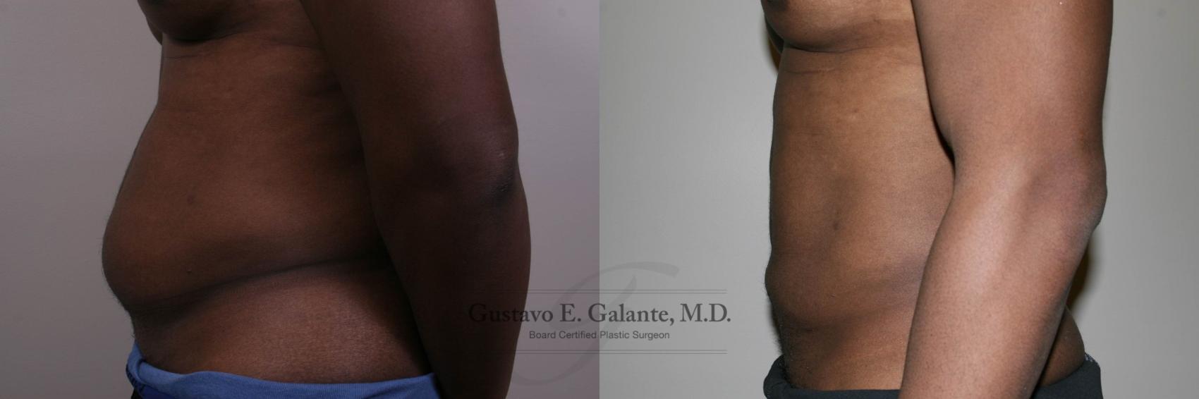 Before & After Liposuction Case 147 View #2 View in Schererville, IN