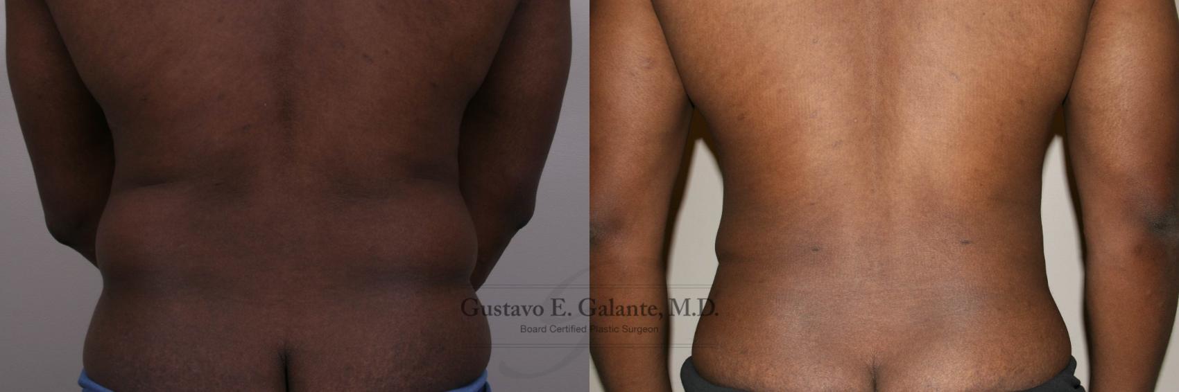 Before & After Liposuction Case 147 View #3 View in Schererville, IN