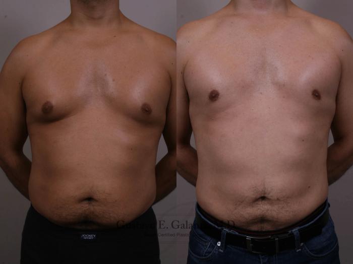 Before & After Liposuction Case 150 View #1 View in Schererville, IN