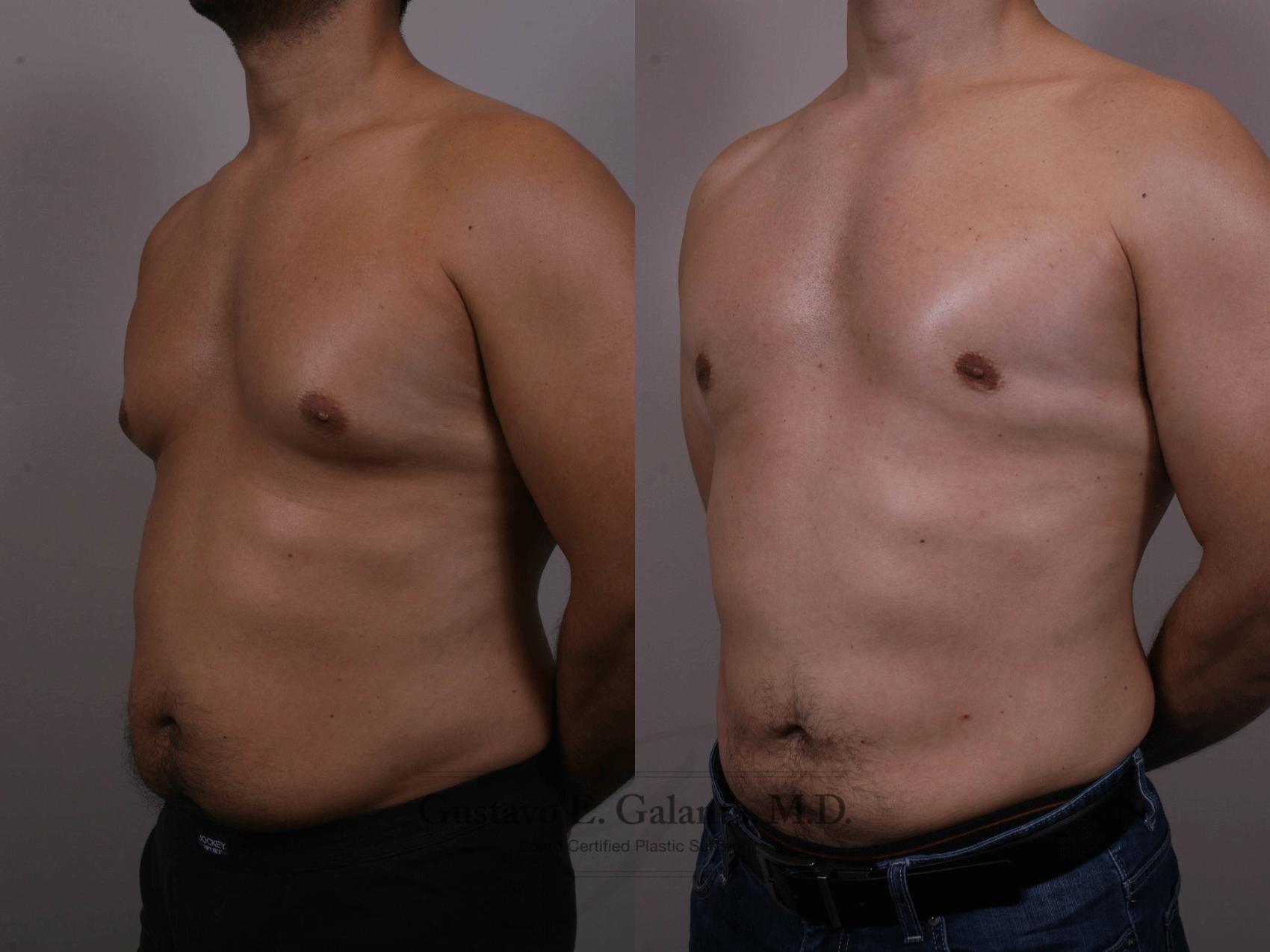 Before & After Liposuction Case 150 View #2 View in Schererville, IN