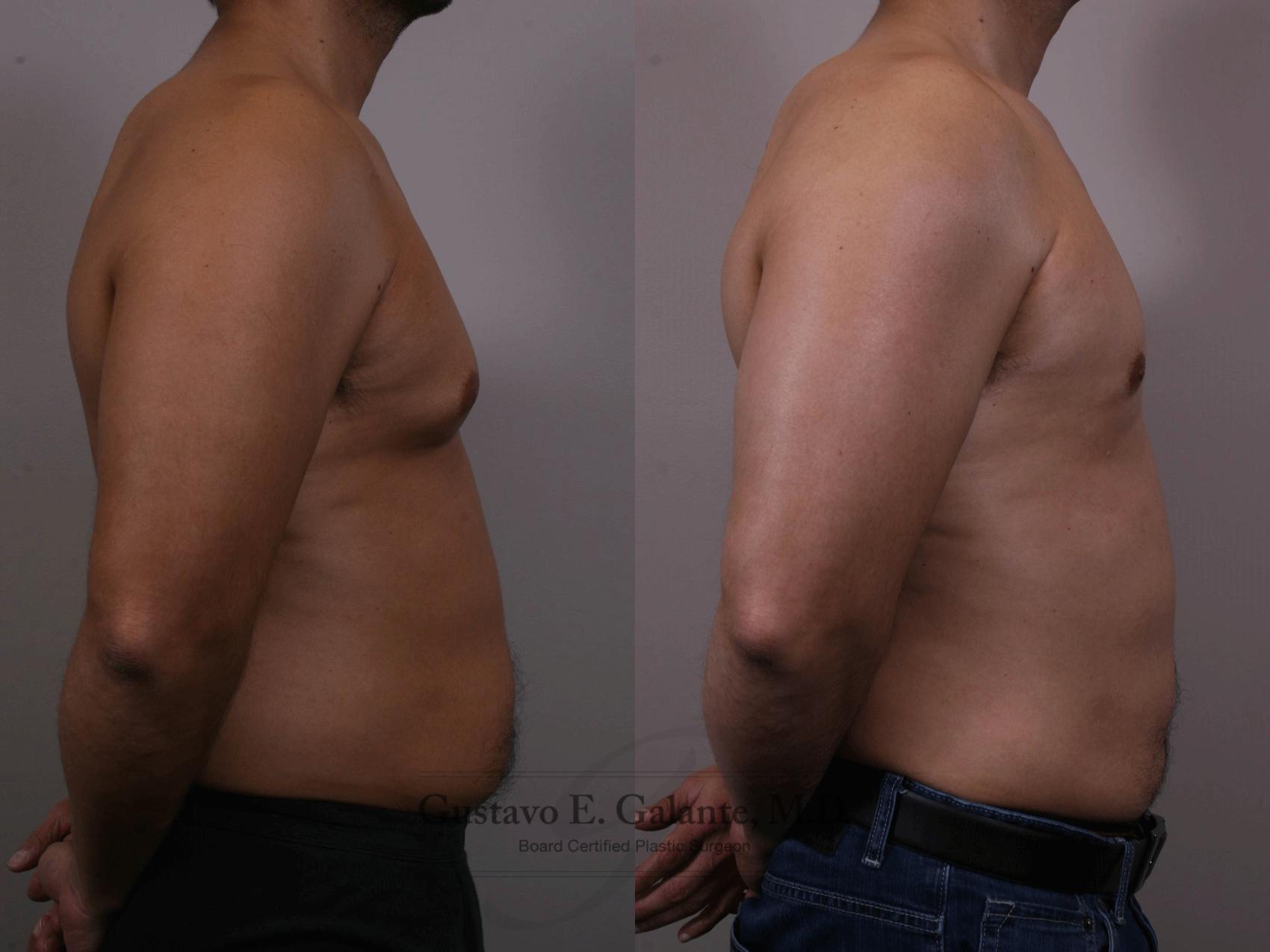 Before & After Liposuction Case 150 View #3 View in Schererville, IN