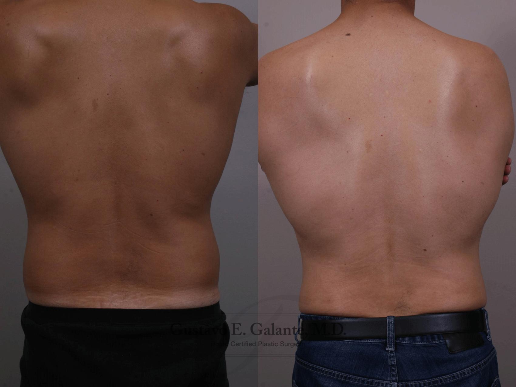 Before & After Liposuction Case 150 View #4 View in Schererville, IN