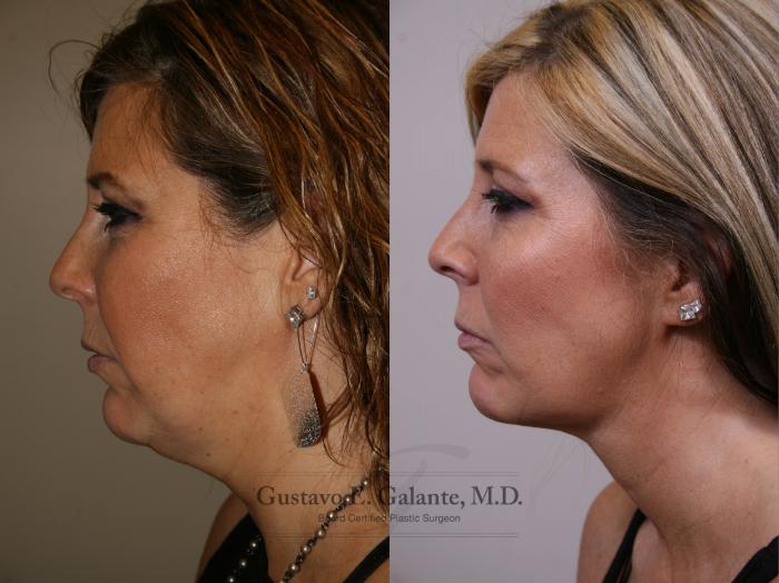 Before & After Liposuction Case 155 View #1 View in Schererville, IN