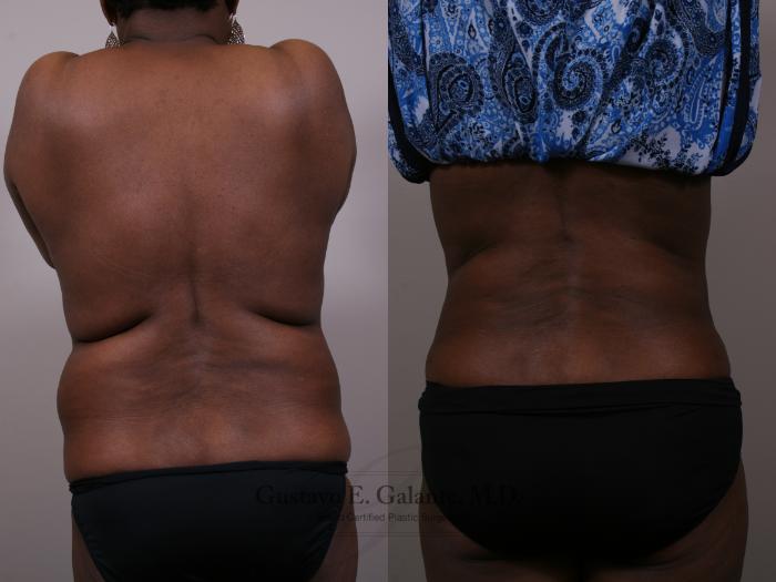 Plastic Surgery Case Study - Full Tummy Tuck and Flank Liposuction Before  Weight Loss - Explore Plastic Surgery
