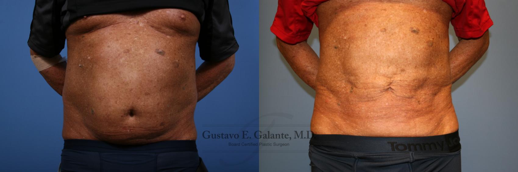 Before & After Liposuction Case 208 Front View in Schererville, IN