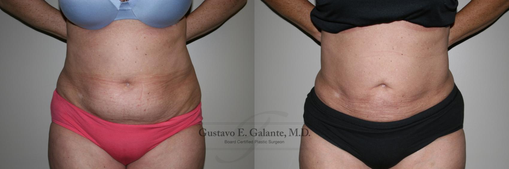 Before & After Liposuction Case 214 Front View in Schererville, IN