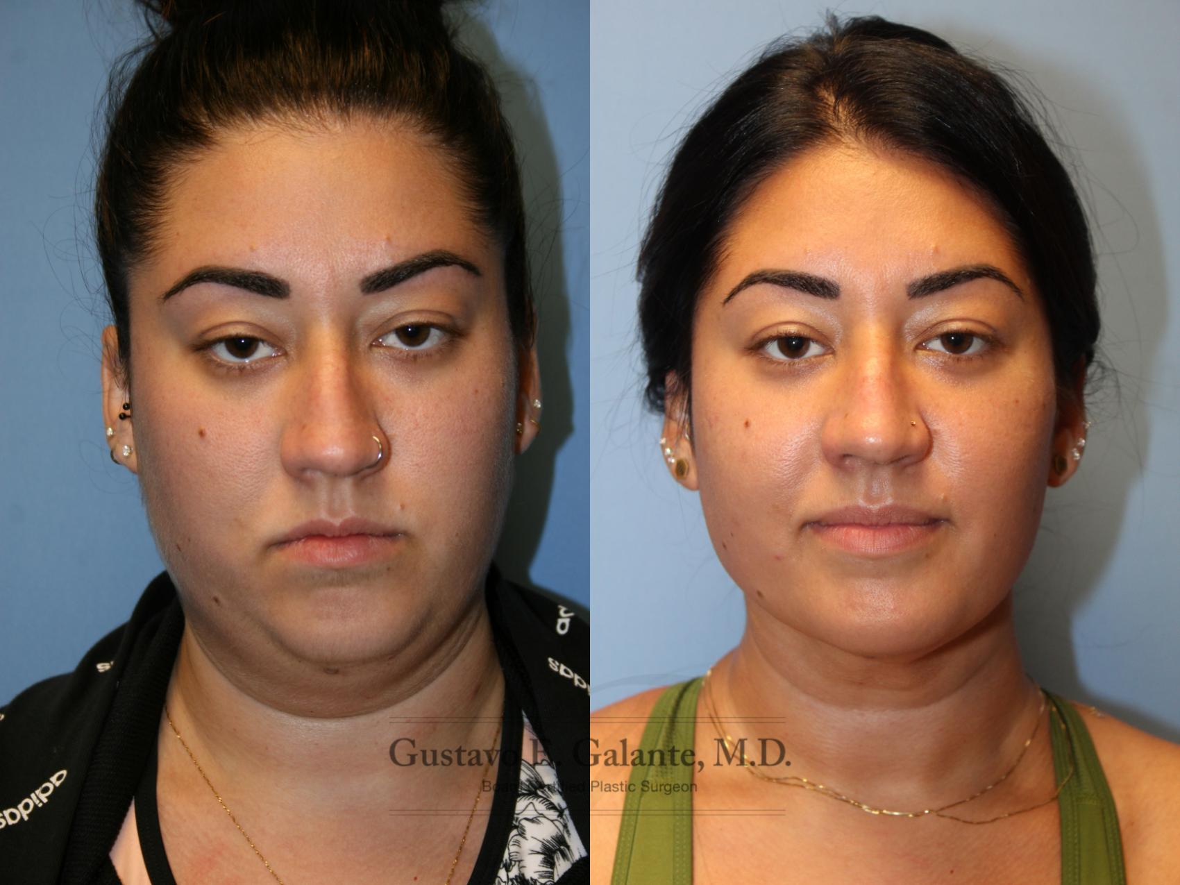 Before & After Liposuction Case 218 Front View in Schererville, IN