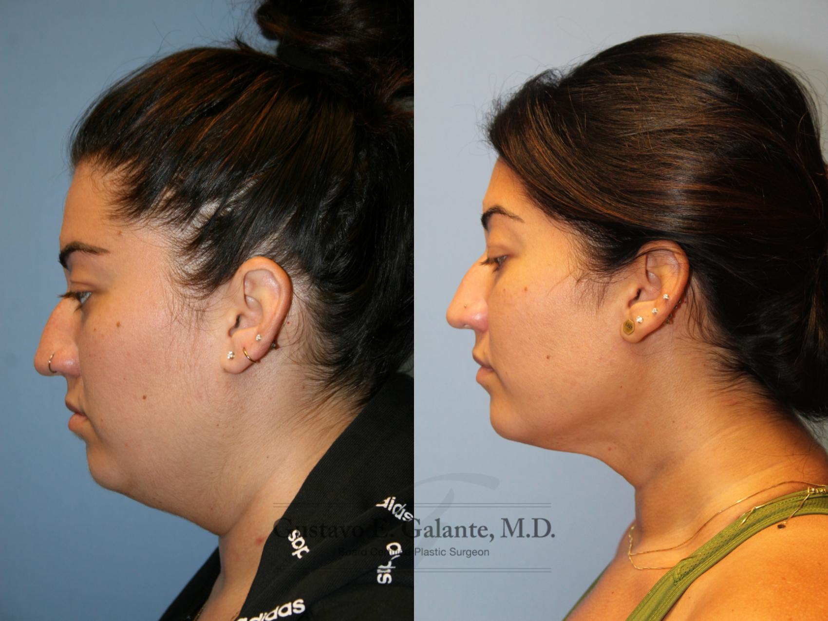Before & After Liposuction Case 218 Left Side View in Schererville, IN