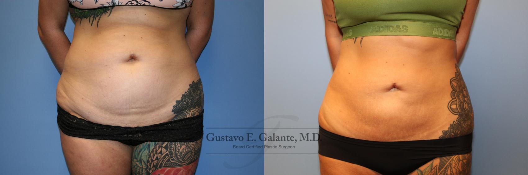 Before & After Liposuction Case 219 Front View in Schererville, IN