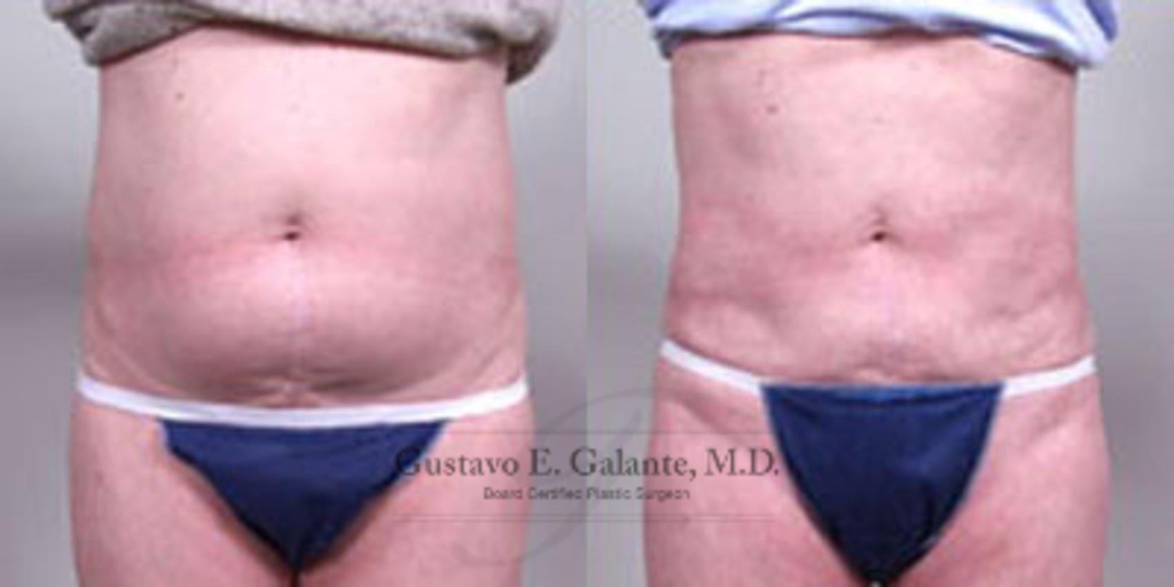 Before & After Liposuction Case 28 View #1 View in Schererville, IN