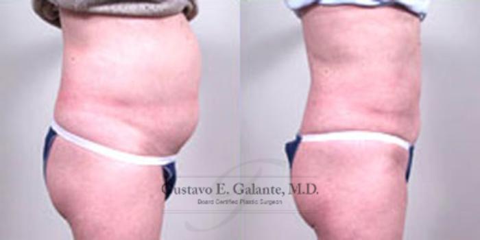 Before & After Liposuction Case 28 View #2 View in Schererville, IN