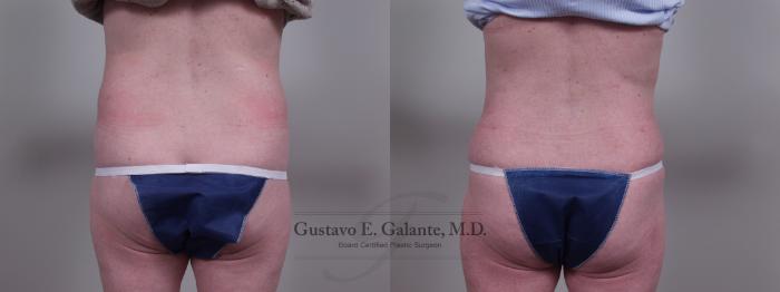 Before & After Liposuction Case 28 View #3 View in Schererville, IN