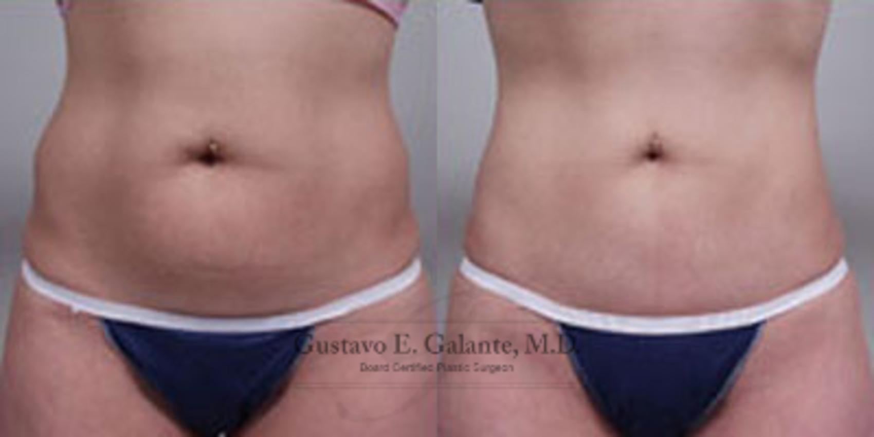Before & After Liposuction Case 32 View #1 View in Valparaiso & Schererville, IN
