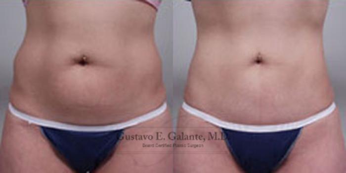 Before & After Liposuction Case 32 View #1 View in Schererville, IN