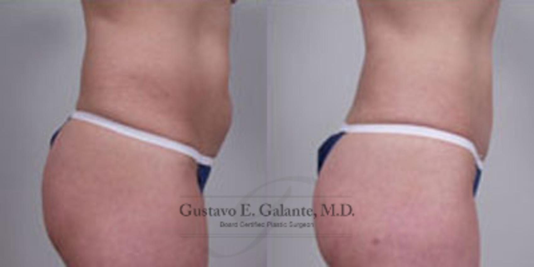 Before & After Liposuction Case 32 View #2 View in Schererville, IN