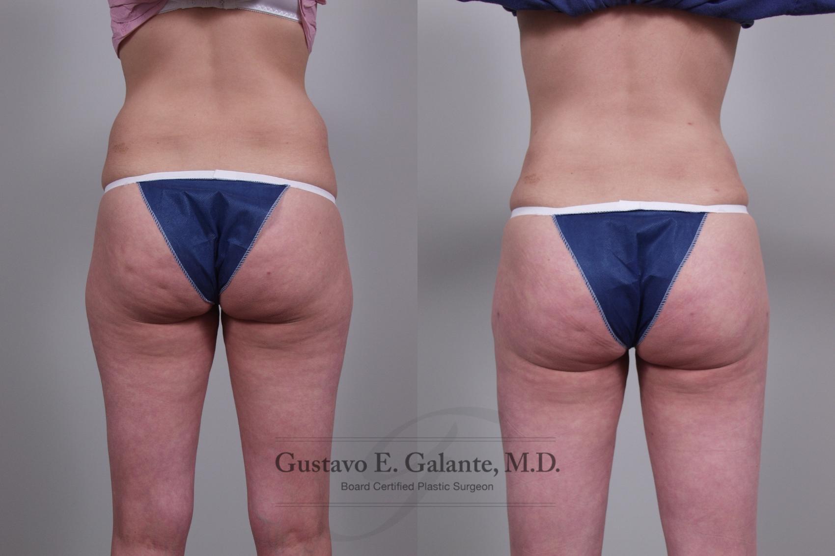 Before & After Liposuction Case 32 View #3 View in Schererville, IN