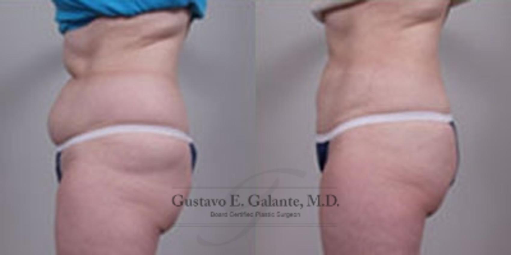 Before & After Liposuction Case 33 View #1 View in Schererville, IN