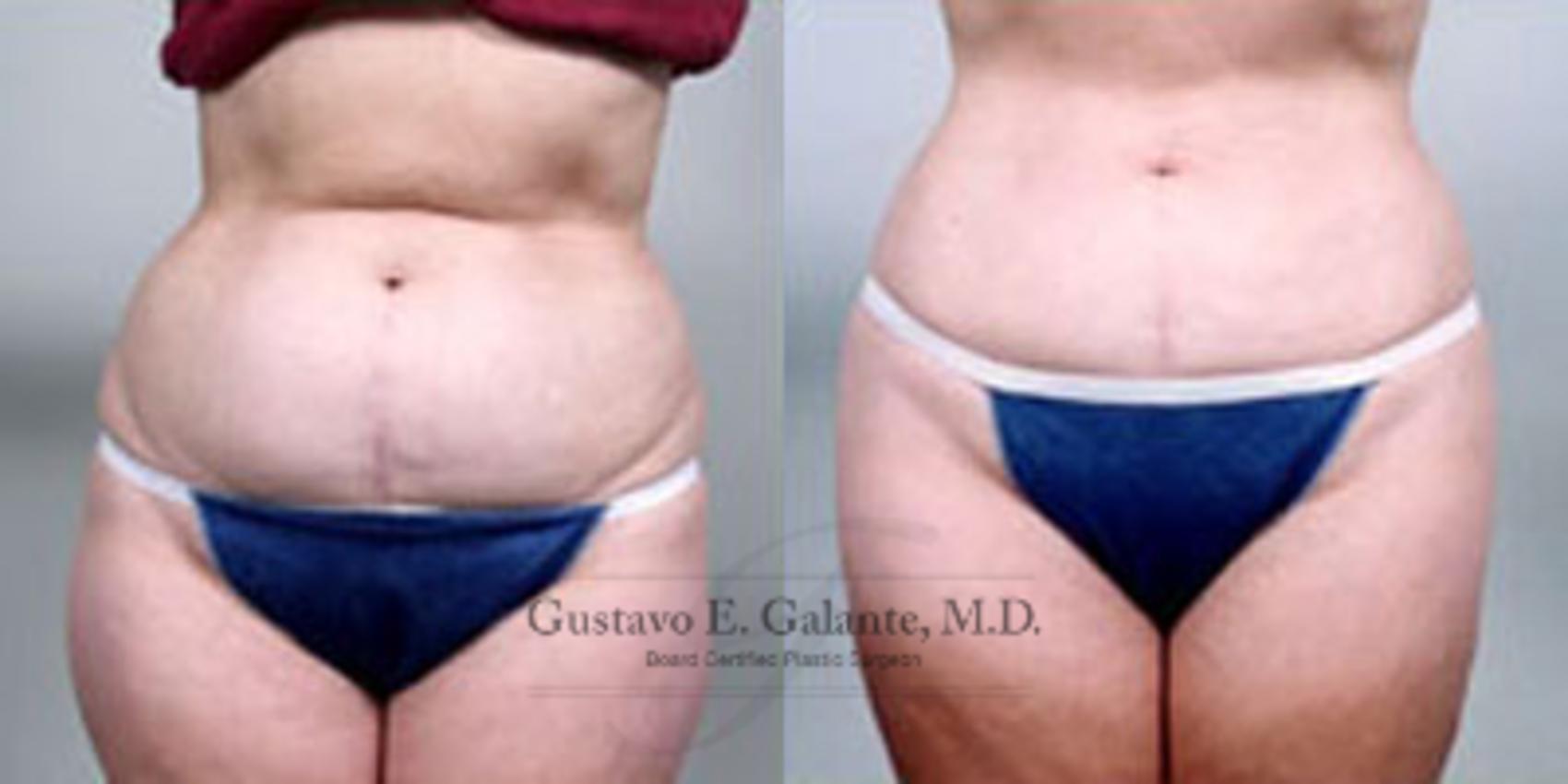 Before & After Liposuction Case 34 View #1 View in Schererville, IN