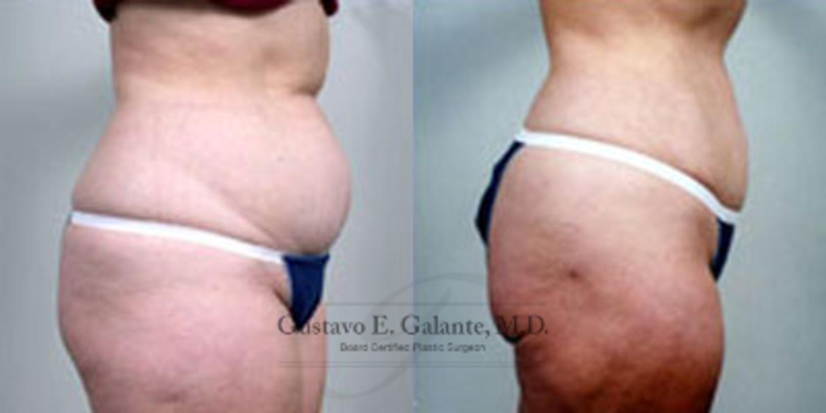 Before & After Liposuction Case 34 View #2 View in Schererville, IN