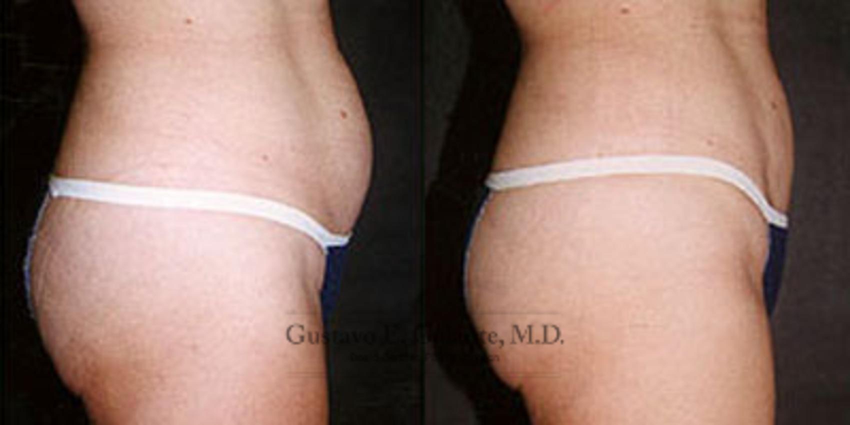 Before & After Liposuction Case 37 View #1 View in Schererville, IN