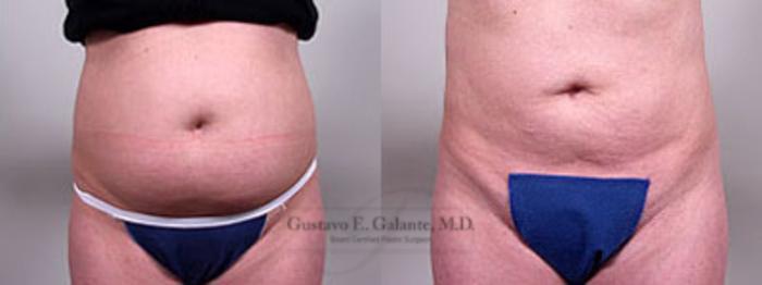 Before & After Liposuction Case 38 View #1 View in Schererville, IN