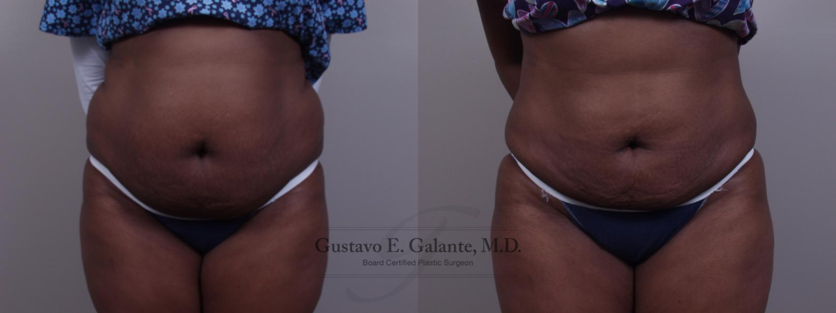 Before & After Liposuction Case 61 View #1 View in Schererville, IN