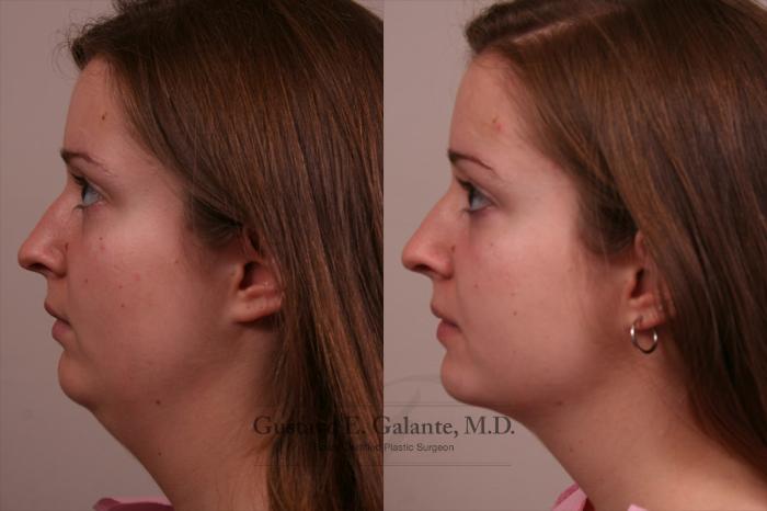 Before & After Liposuction Case 97 View #1 View in Schererville, IN