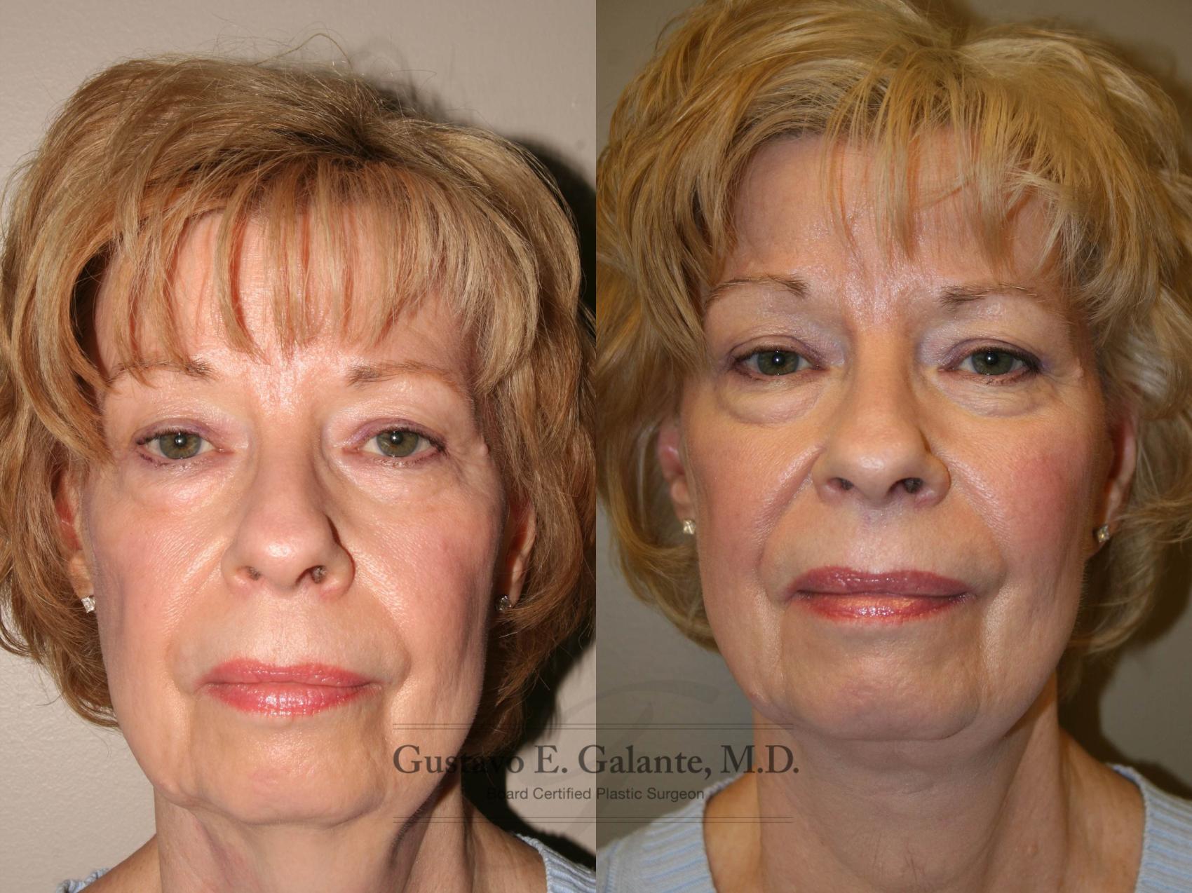 Before & After Neck Lift Case 126 View #1 View in Schererville, IN