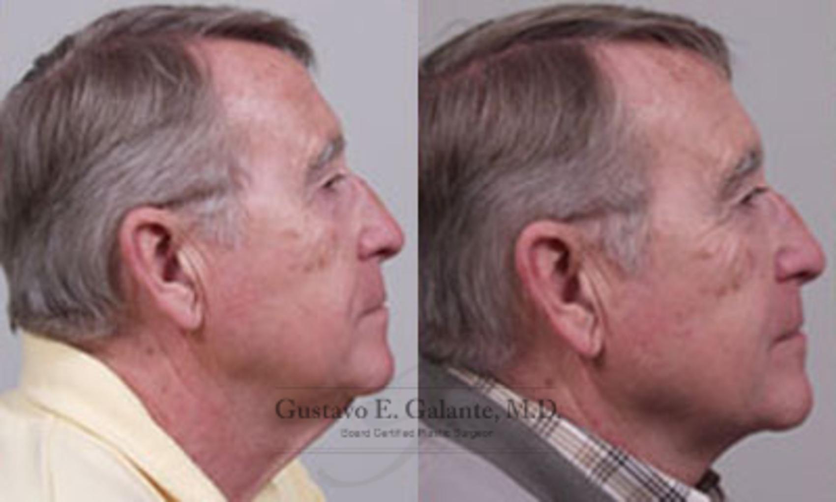Before & After Neck Lift Case 17 View #1 View in Schererville, IN