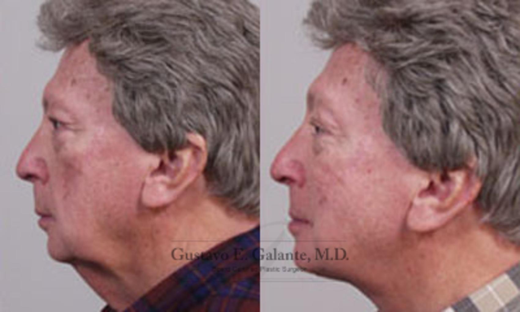 Before & After Neck Lift Case 18 View #1 View in Valparaiso & Schererville, IN