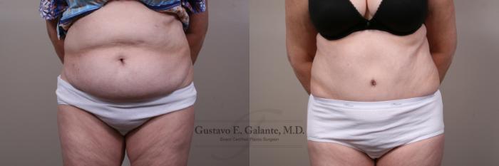 Before & After Tummy Tuck (Abdominoplasty) Case 164 View #1 View in Schererville, IN