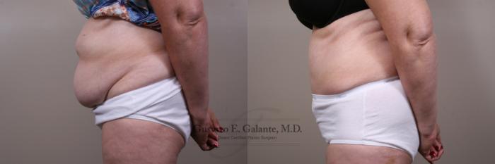 Before & After Tummy Tuck (Abdominoplasty) Case 164 View #2 View in Schererville, IN