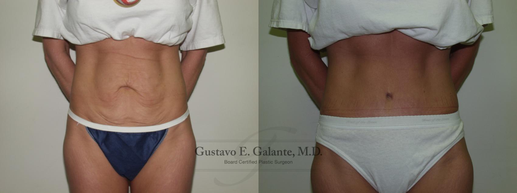 Before & After Tummy Tuck (Abdominoplasty) Case 64 View #1 View in Valparaiso & Schererville, IN
